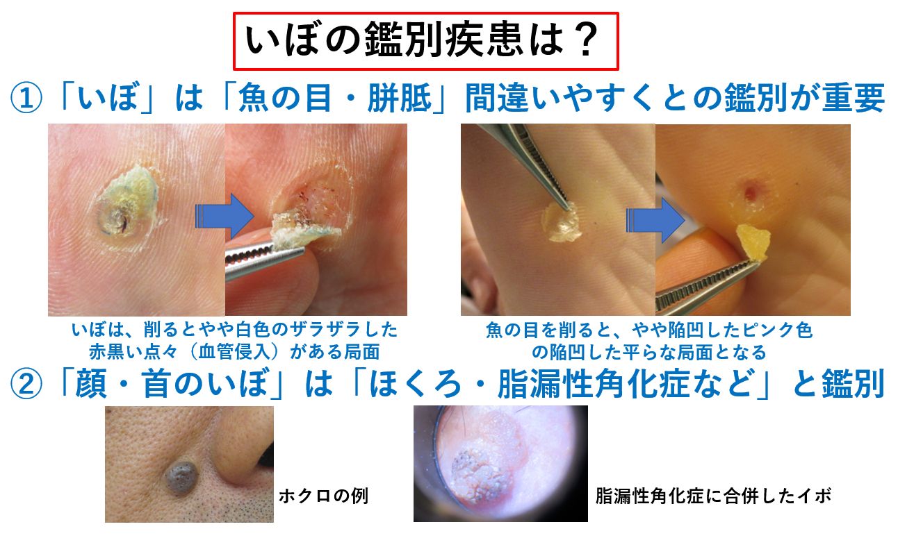 いぼ｜大田区大森・大木皮膚科【尋常性疣贅・イボ治療専門外来】