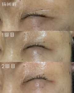 ラミネーションピール回数重ねた経過 - フェイシャルエステ・毛穴洗浄