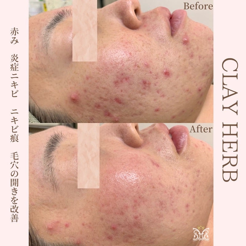 本気の方必見！！剥離ありハーブor剥離なしハーブのおすすめポイントは