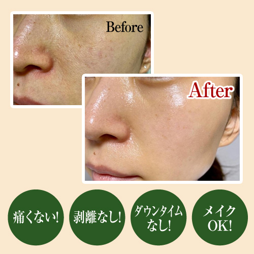 46％OFF】結果重視☆剥離なし【OHLハーブピーリング】肌トラブルでお